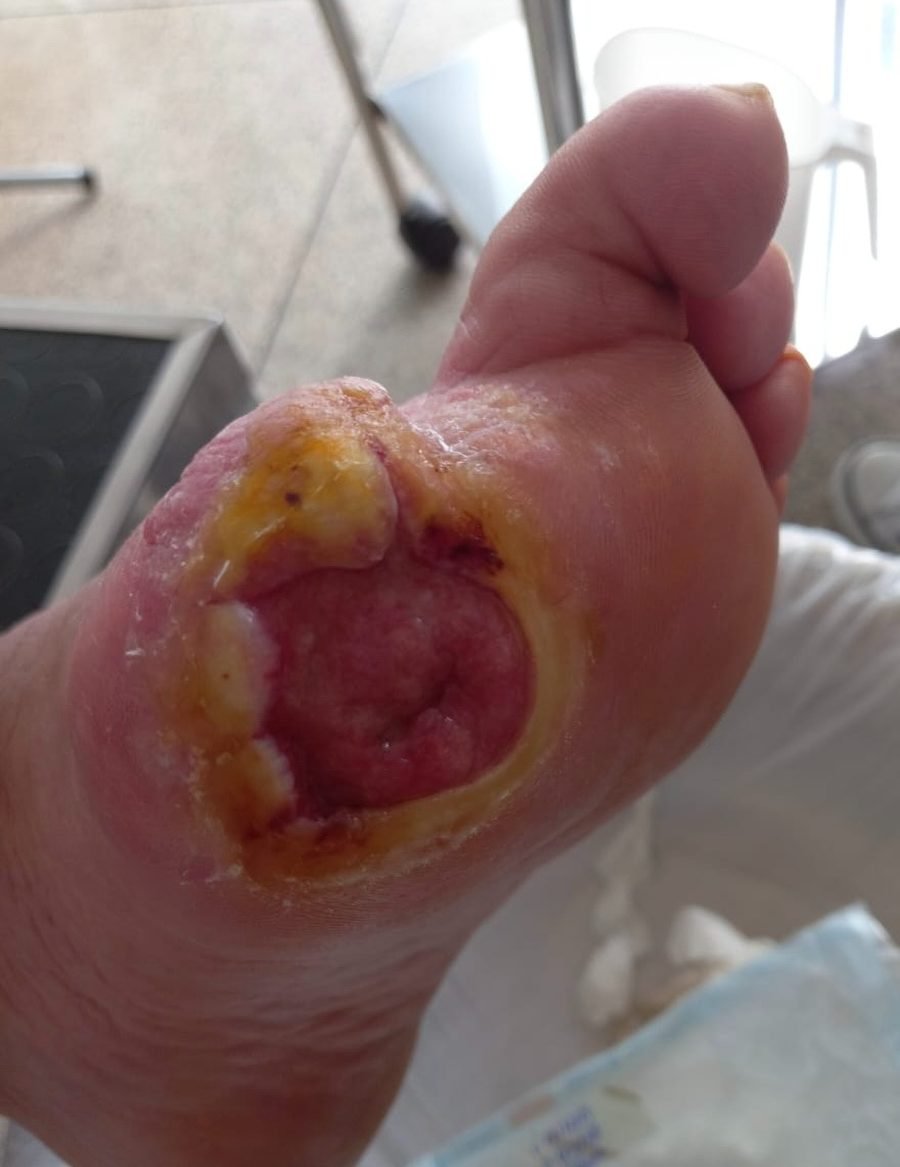 Imagem clínica desfocada. Pé diabético no início do acompanhamento.