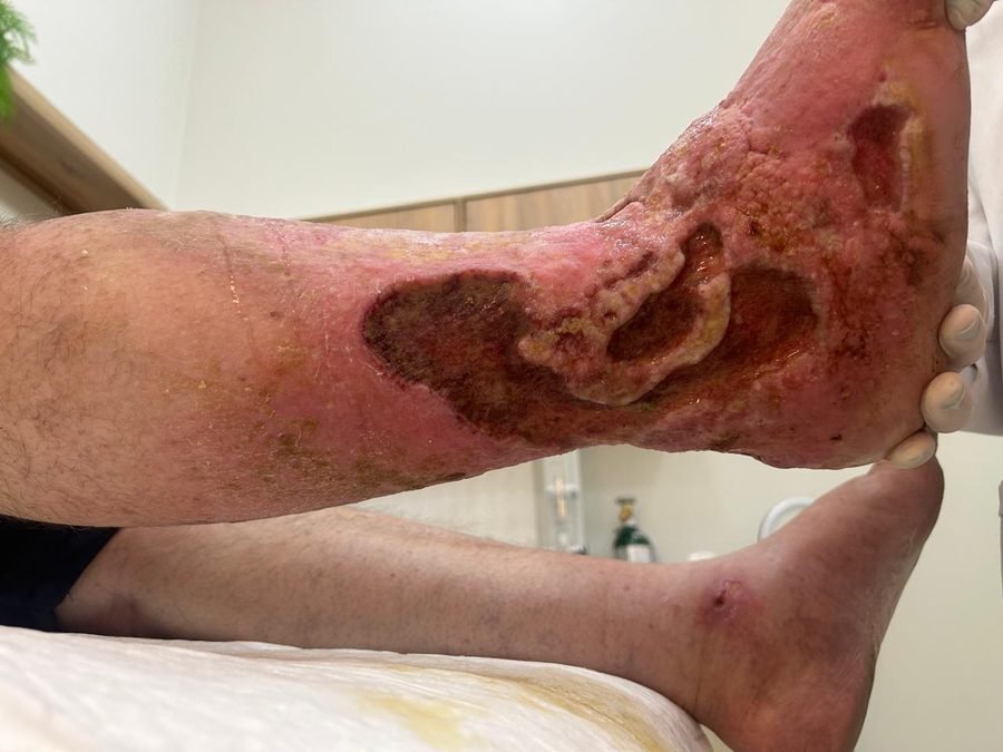 Imagem clínica desfocada. Úlcera venosa no início do acompanhamento.