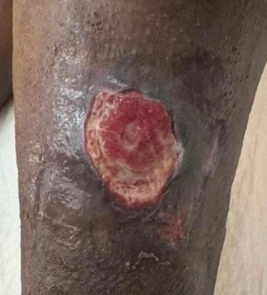 Imagem clínica desfocada. Úlcera arterial no início do acompanhamento.