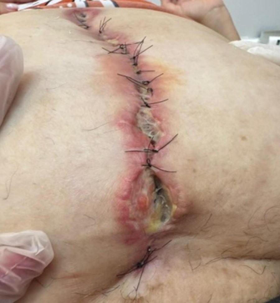 Imagem clínica desfocada. Deiscência pós-cirúrgica no início do acompanhamento.