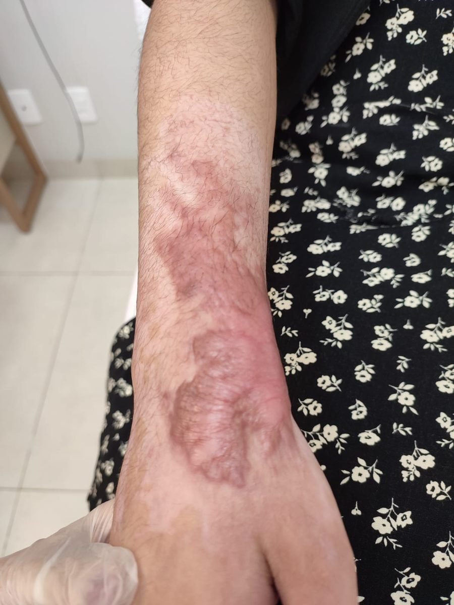 Imagem clínica desfocada. Queloide no início do acompanhamento.