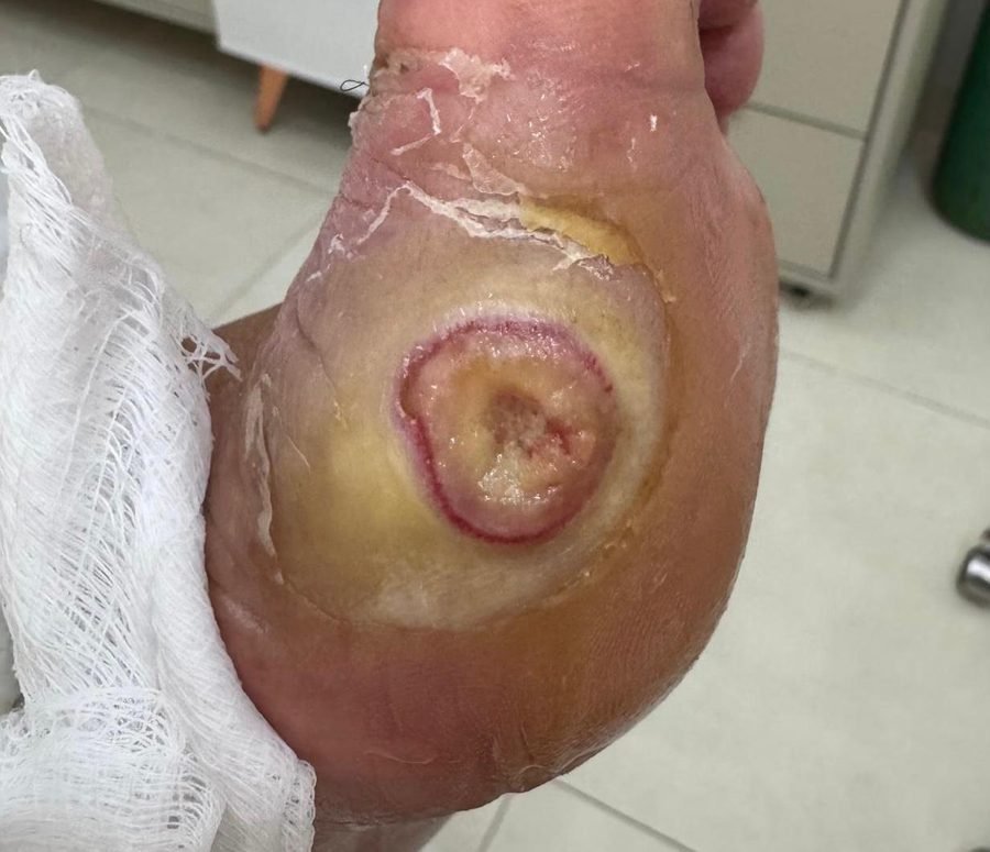 Imagem clínica desfocada. Pé diabético no início do acompanhamento.