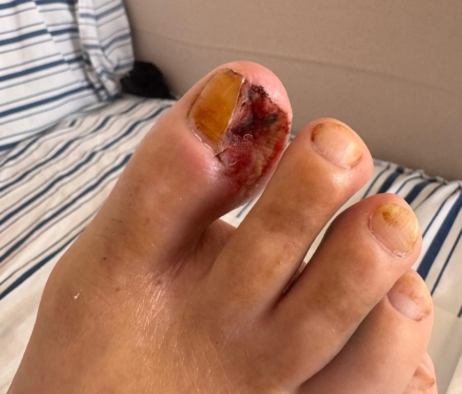 Imagem clínica desfocada. Pé diabético no início do acompanhamento.