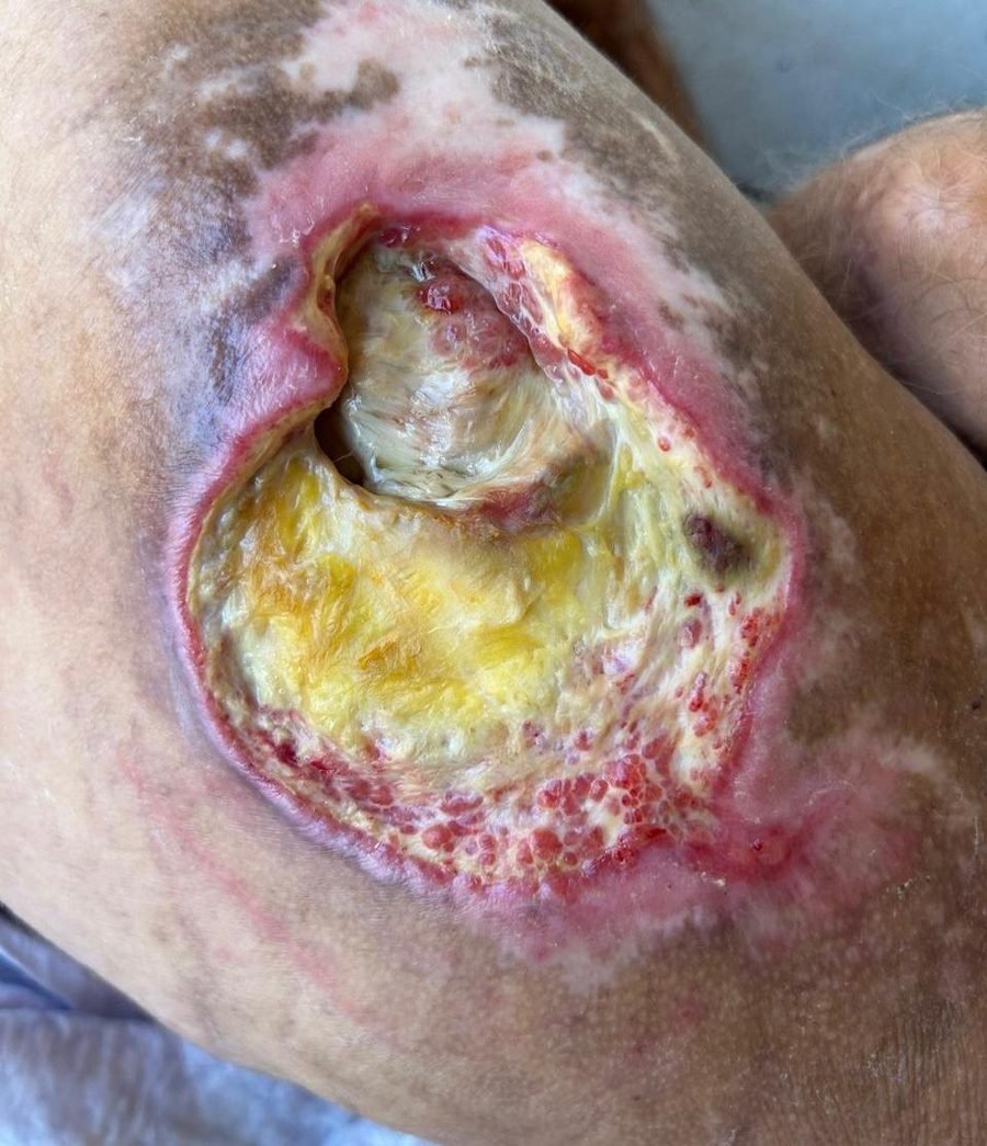 Imagem clínica desfocada. Lesão por pressão no início do acompanhamento.