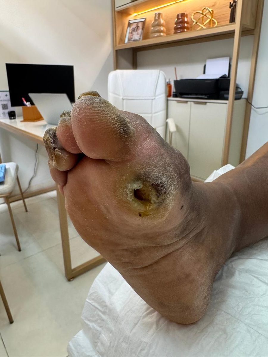 Imagem clínica desfocada. Pé diabético no início do acompanhamento.