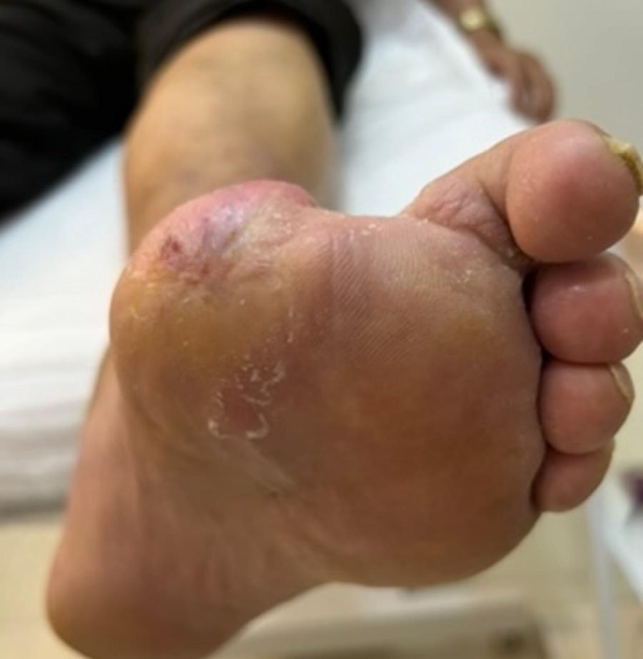 Imagem clínica desfocada. Pé diabético após 5 meses de acompanhamento.