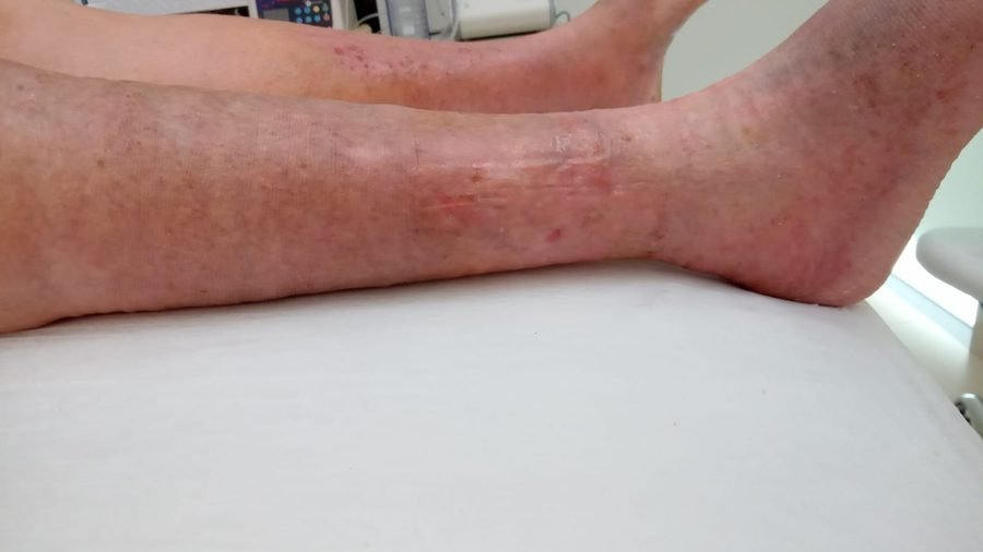 Imagem clínica desfocada. Erisipela bolhosa após 4 meses de acompanhamento.