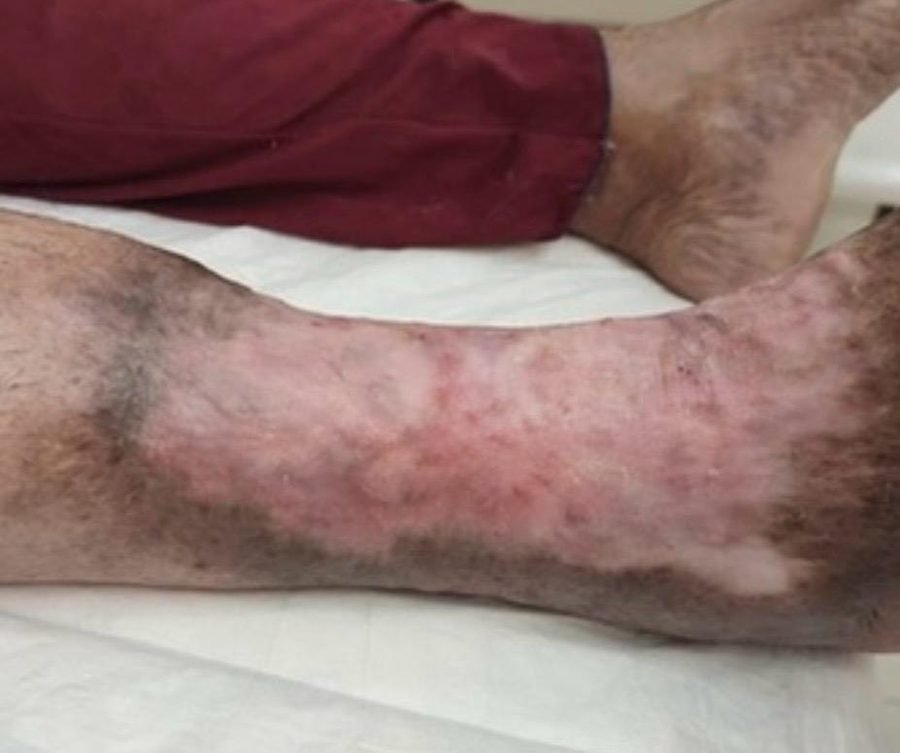 Imagem clínica desfocada. Úlcera venosa após 8 meses de acompanhamento.