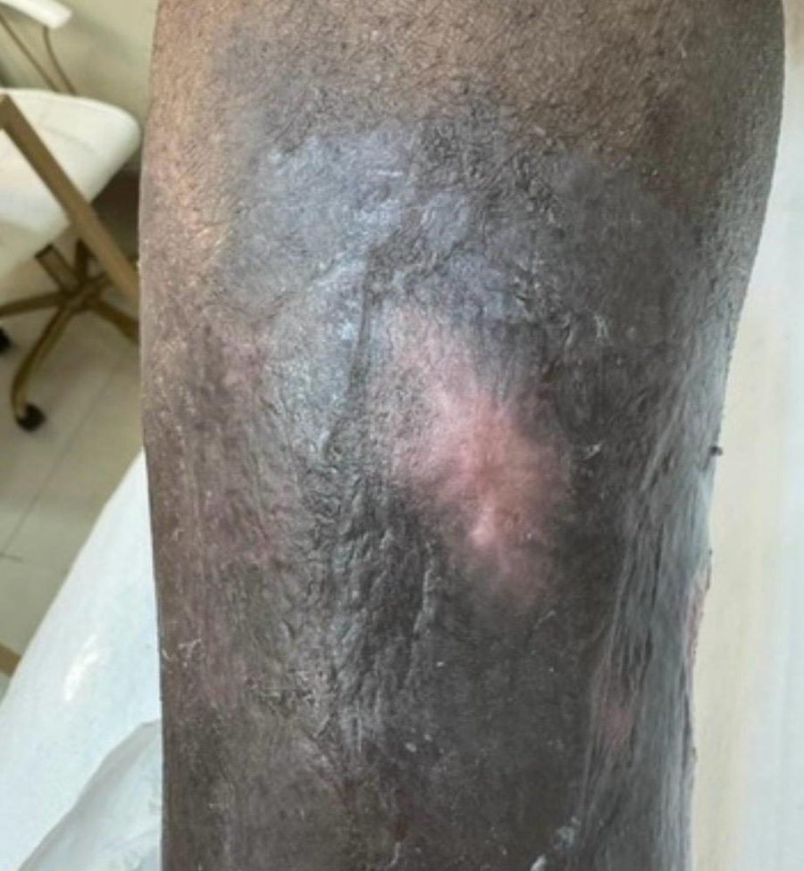 Imagem clínica desfocada. Úlcera arterial após 5 meses de acompanhamento.