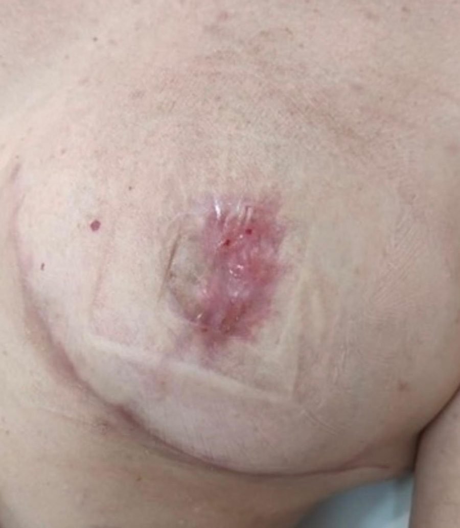 Imagem clínica desfocada. Deiscência pós-cirúrgica após 3 meses de acompanhamento.