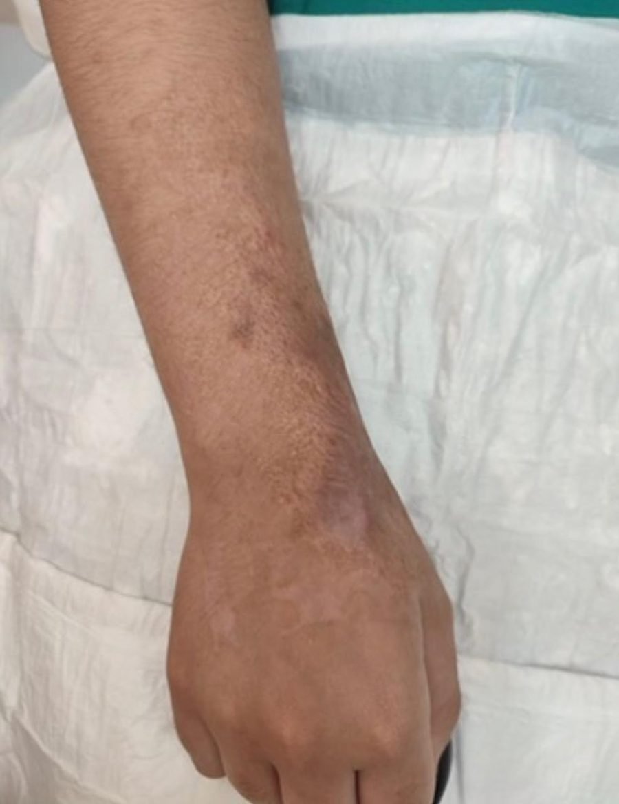 Imagem clínica desfocada. Queloide após 6 meses de acompanhamento.