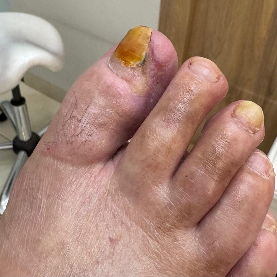 Imagem clínica desfocada. Pé diabético após 1 mês de acompanhamento.