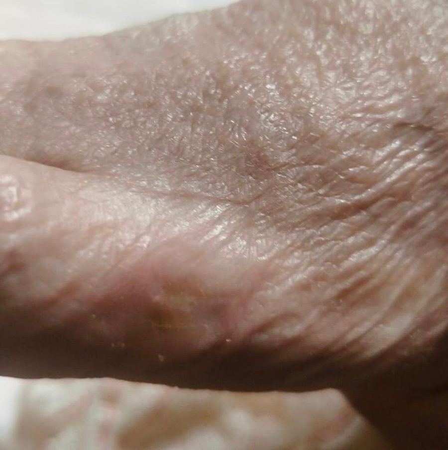 Imagem clínica desfocada. Pé diabético após 3 meses de acompanhamento.