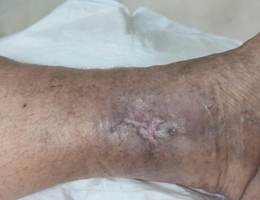 Imagem clínica desfocada. Úlcera mista após 5 meses de acompanhamento.