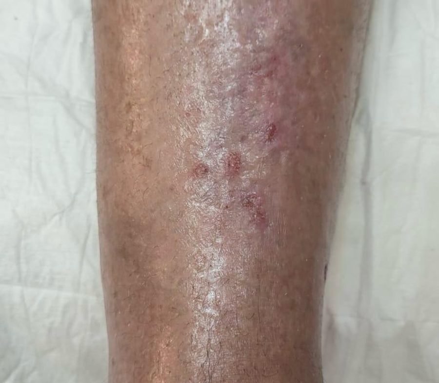 Imagem clínica desfocada. Úlcera mista após 5 meses de acompanhamento.