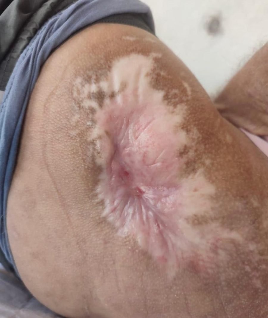 Imagem clínica desfocada. Lesão por pressão após 5 meses de acompanhamento.